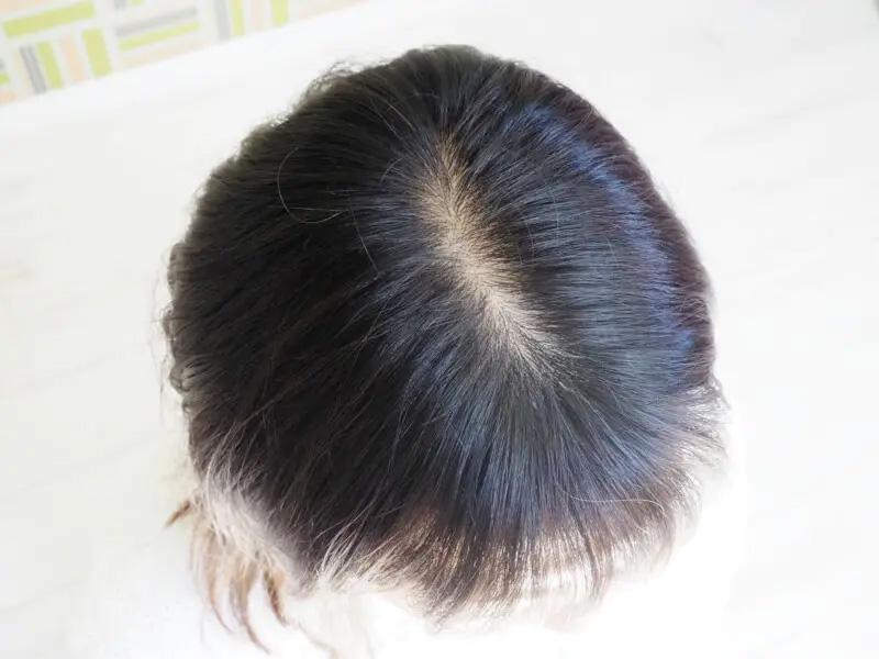 抜毛症/医療用ウィッグ