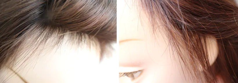 医療用ウィッグ/分け目・産毛の調整