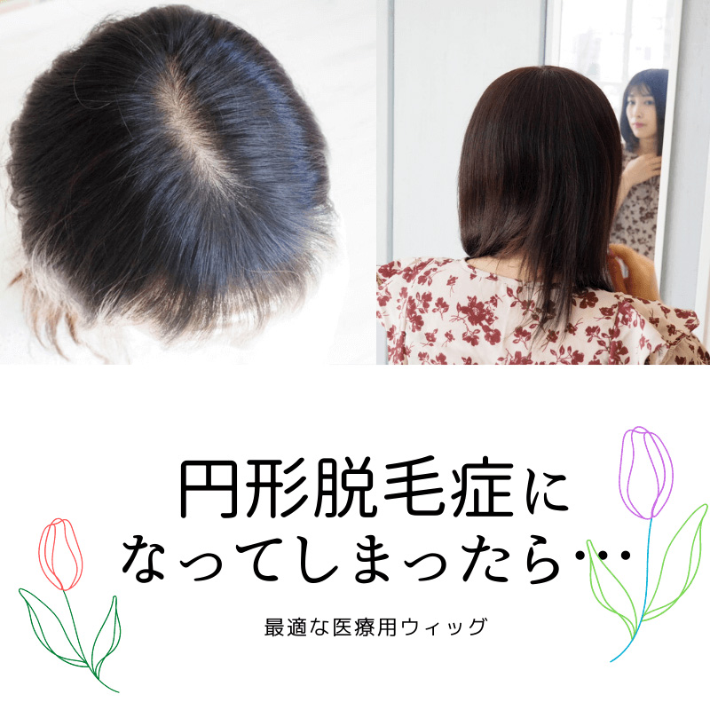 医療用ウィッグ/円形脱毛症