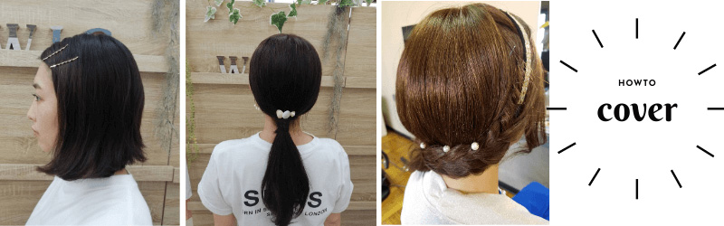 円形脱毛症/ヘアーアレンジでカバー