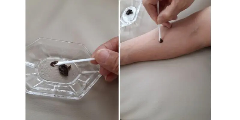 パッチテスト