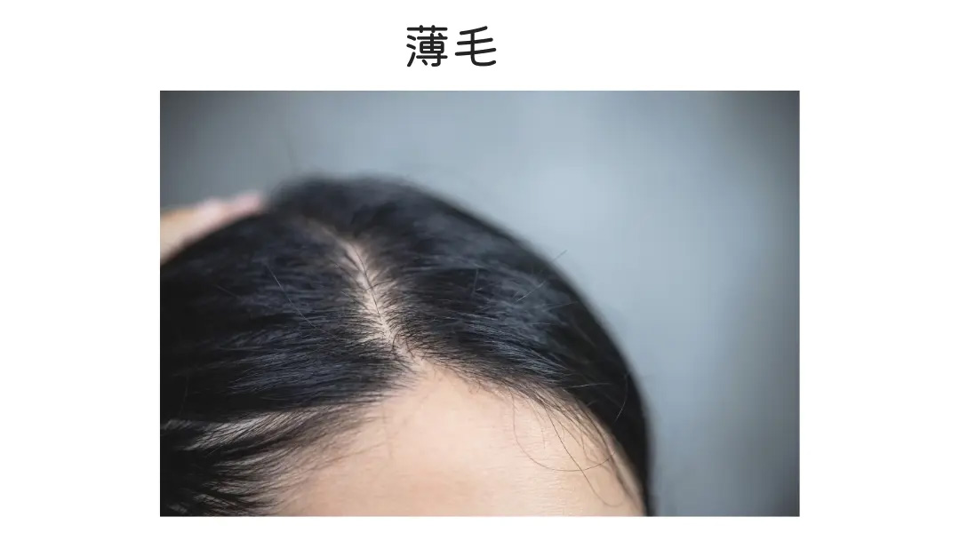 ヘアピース/薄毛 ヘアピース/薄毛