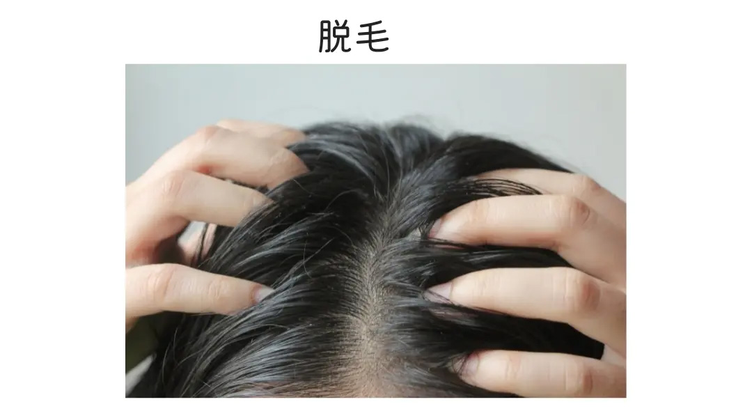 ヘアピース/急に脱毛 ヘアピース/急に脱毛