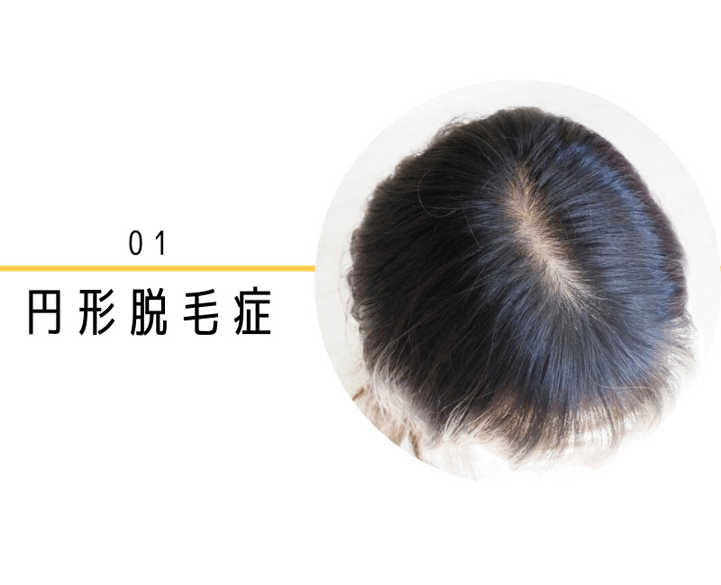 円形脱毛